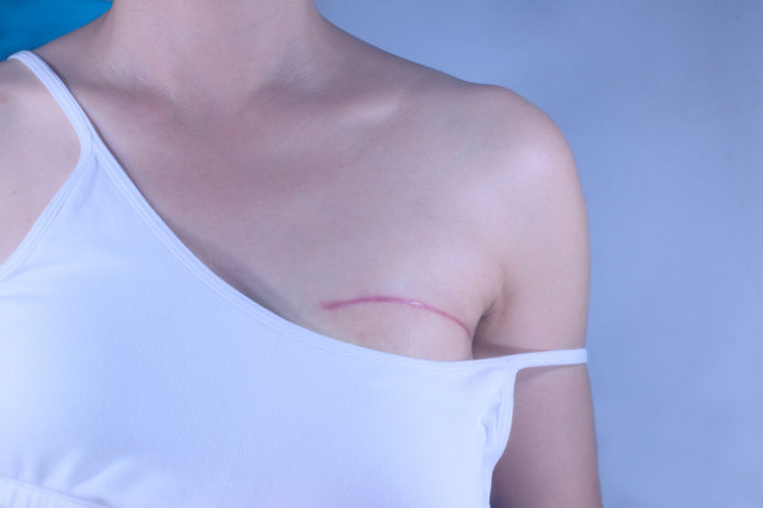Extensive Breast Cancer Surgery Negatively Impacts Psychosocial Outcomes in Survivors