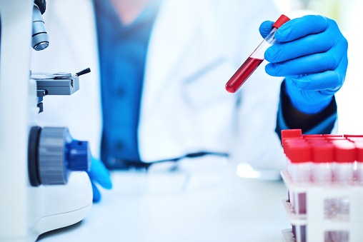 Closeup shot of a scientist analyzing samples in a laboratory A Simple Blood Test that Detects Cancer and Diabetes Complications