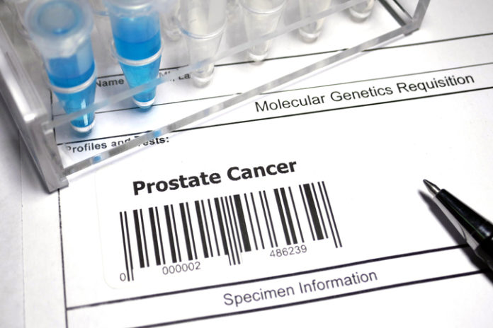 Researchers Propose A New Validated Prostate Cancer Staging System