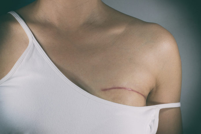 mastectomy, Is It Okay to Delay Surgery in Very Early Breast Cancer?