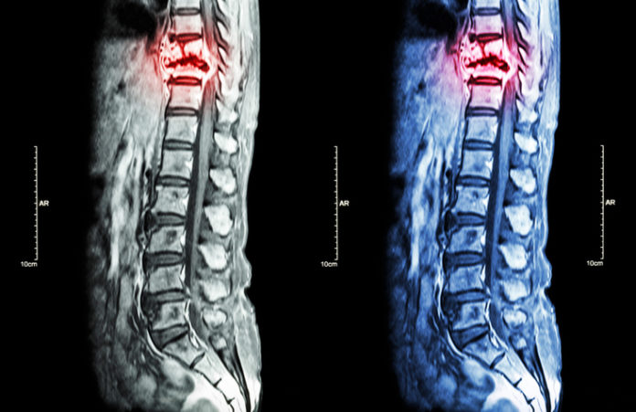 Patients With Spinal Metastases May Be Disappointed After Treatment