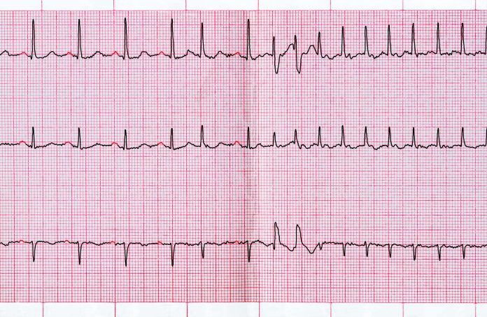 Ventricular Tachycardia Ablation at the Time of ICD Implant Shows Benefit