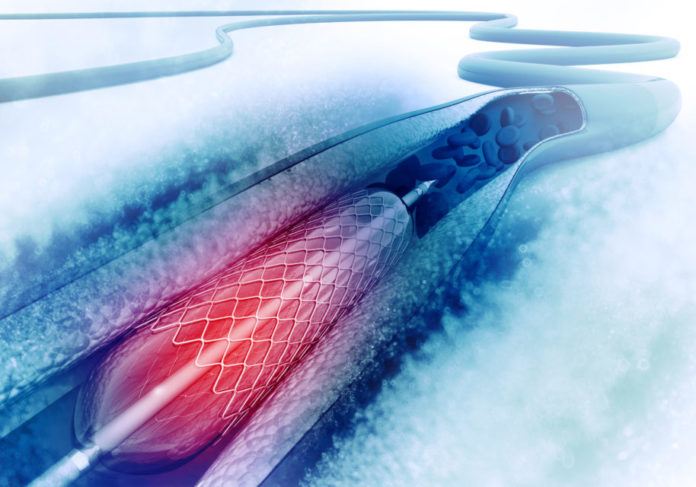 Novel Fixed-Wire DES Does Not Achieve Non-Inferiority vs. Existing Stents